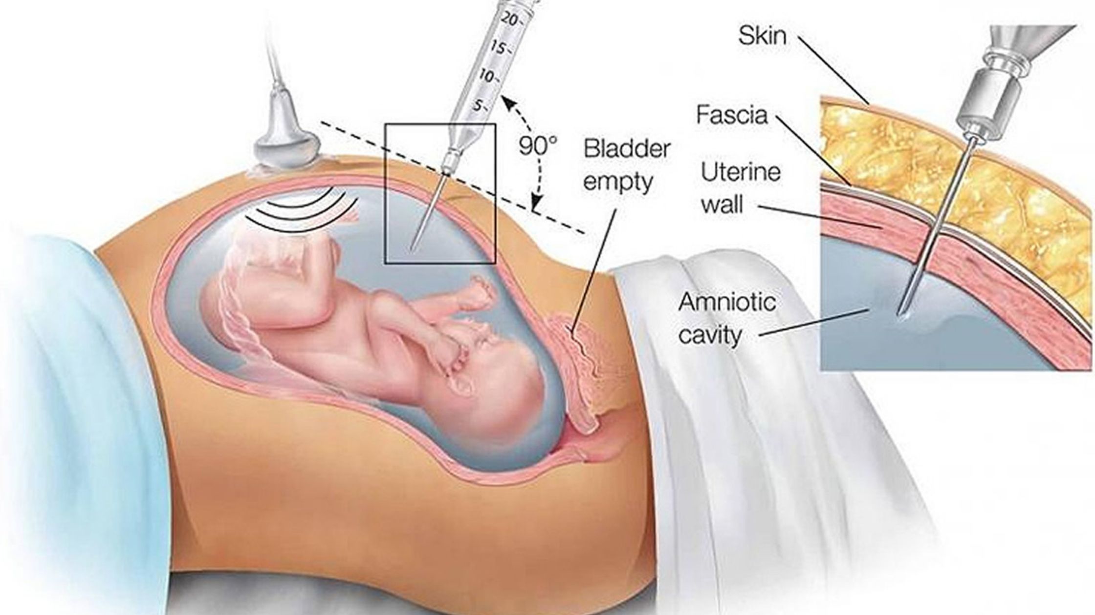 Amniocentesis DNA test procedure